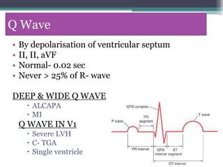 Q Wave
• By depolarisation of ventricular septum
• II, II, aVF
• Normal- 0.02 sec
• Never > 25% of R- wave
DEEP & WIDE Q WAVE
 ALCAPA
 MI
Q WAVE IN V1
 Severe LVH
 C- TGA
 Single ventricle
 