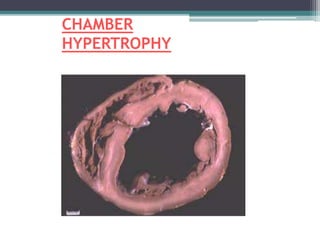 CHAMBER
HYPERTROPHY
 