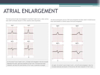 ATRIAL ENLARGEMENT
 