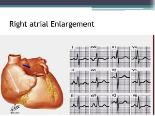 Right atrial Enlargement
 