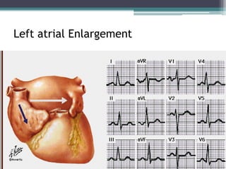 Left atrial Enlargement
 
