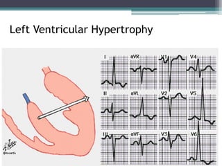 Left Ventricular Hypertrophy
 