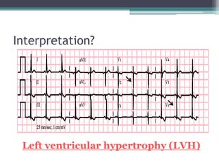 Interpretation?
Left ventricular hypertrophy (LVH)
 