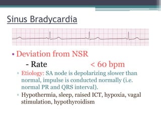 Sinus Bradycardia
• Deviation from NSR
- Rate < 60 bpm
▫ Etiology: SA node is depolarizing slower than
normal, impulse is conducted normally (i.e.
normal PR and QRS interval).
▫ Hypothermia, sleep, raised ICT, hypoxia, vagal
stimulation, hypothyroidism
 