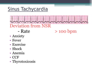 Sinus Tachycardia
Deviation from NSR
- Rate > 100 bpm
• Anxiety
• Fever
• Exercise
• Shock
• Anemia
• CCF
• Thyrotoxicosis
 