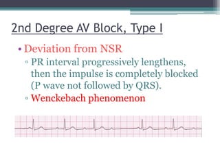 2nd Degree AV Block, Type I
• Deviation from NSR
▫ PR interval progressively lengthens,
then the impulse is completely blocked
(P wave not followed by QRS).
▫ Wenckebach phenomenon
 