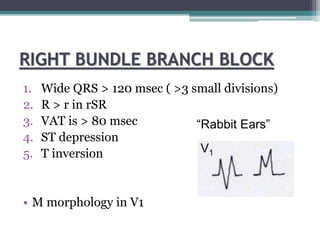 RIGHT BUNDLE BRANCH BLOCK
1. Wide QRS > 120 msec ( >3 small divisions)
2. R > r in rSR
3. VAT is > 80 msec
4. ST depression
5. T inversion
• M morphology in V1
V1
“Rabbit Ears”
 