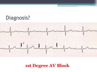 Diagnosis?
p
1st Degree AV Block
 
