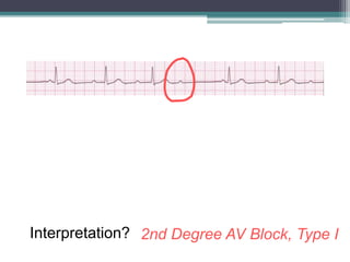 Interpretation? 2nd Degree AV Block, Type I
 