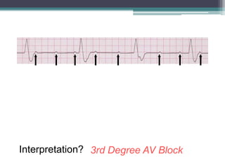 Interpretation? 3rd Degree AV Block
 