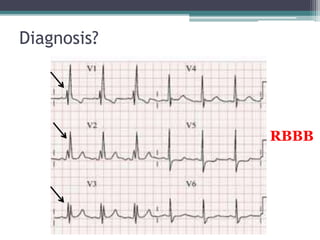 Diagnosis?
RBBB
 