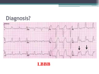 Diagnosis?
LBBB
 