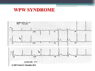 WPW SYNDROME
 