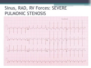 Sinus, RAD, RV Forces: SEVERE
PULMONIC STENOSIS
 