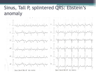 Sinus, Tall P
, splintered QRS: Ebstein’s
anomaly
 