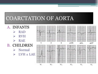 COARCTATION OF AORTA
A. INFANTS
 RAD
 RVH
 RAE
B. CHILDREN
 Normal
 LVH ± LAE
 