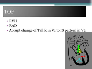 TOF
• RVH
• RAD
• Abrupt change of Tall R in V1 to rS pattern in V2
 