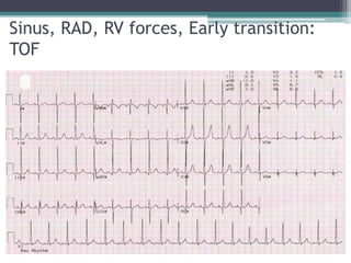 Sinus, RAD, RV forces, Early transition:
TOF
 