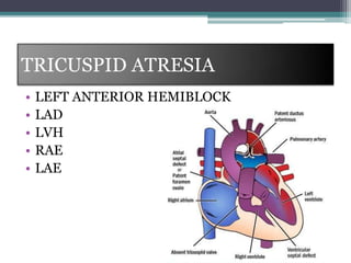 TRICUSPID ATRESIA
• LEFT ANTERIOR HEMIBLOCK
• LAD
• LVH
• RAE
• LAE
 