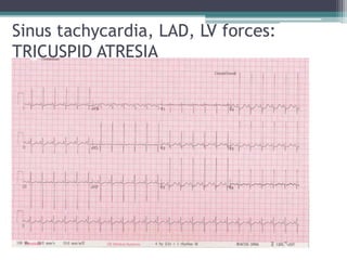 Sinus tachycardia, LAD, LV forces:
TRICUSPID ATRESIA
 