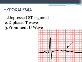 HYPOKALEMIA
1.Depressed ST segment
2.Diphasic T wave
3.Prominent U Wave
 
