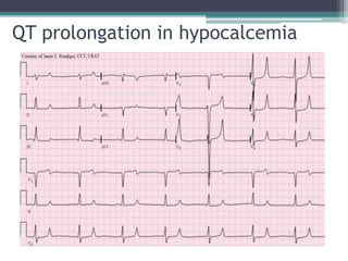 QT prolongation in hypocalcemia
 