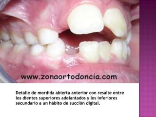 Detalle de mordida abierta anterior con resalte entre
los dientes superiores adelantados y los inferiores
secundario a un hábito de succión digital.
 