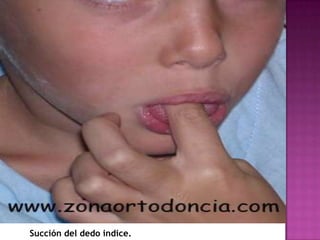 Succión del dedo indice.
 