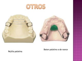 Boton palatino o de nance
Rejilla palatina
 