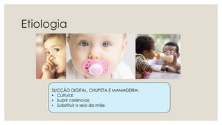 Etiologia
SUCÇÃO DIGITAL, CHUPETA E MAMADEIRA:
• Cultural;
• Suprir carências;
• Substituir o seio da mãe.
 