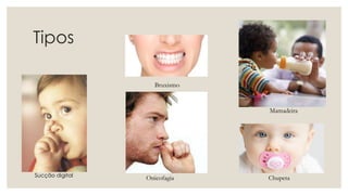 Tipos
Sucção digital Onicofagia Chupeta
Mamadeira
Bruxismo
 