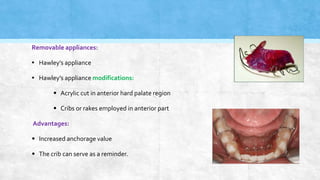 Crib Or Rake Oral Habits in Children. Part II: Tongue thrusting,Mouth Breathing ...