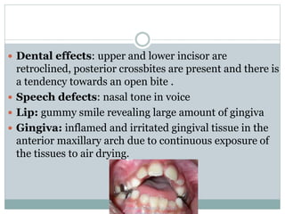  Dental effects: upper and lower incisor are
retroclined, posterior crossbites are present and there is
a tendency towards an open bite .
 Speech defects: nasal tone in voice
 Lip: gummy smile revealing large amount of gingiva
 Gingiva: inflamed and irritated gingival tissue in the
anterior maxillary arch due to continuous exposure of
the tissues to air drying.
 