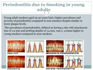 Periodontitis due to Smoking in young
adults
Young adult smokers aged 19-30 years had a higher prevalence and
severity of periodontitis compared to non-smokers despite similar or
lower plaque levels.
The prevalence of periodontitis, defined as having a site with attachment
loss of ≥2 mm and probing depths of ≥4 mm, was 3 -4 times higher in
young smokers compared to non-smokers.
 