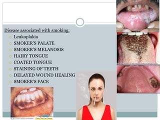 Disease associated with smoking:
 Leukoplakia
 SMOKER’S PALATE
 SMOKER’S MELANOSIS
 HAIRY TONGUE
 COATED TONGUE
 STAINING OF TEETH
 DELAYED WOUND HEALING
 SMOKER’S FACE
 