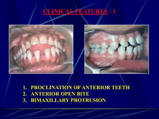CLINICAL FEATURES - 1
1. PROCLINATION OF ANTERIOR TEETH
2. ANTERIOR OPEN BITE
3. BIMAXILLARY PROTRUSION
 