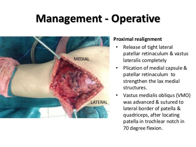 Habitual dislocation of patella