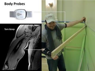 Body	
  Probes




Torn	
  bicep
 