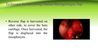 Technique for harvesting Hadad-Bassagasteguy flap
• Reverse flap is harvested on
other side, to cover the bare
cartilage. Once harvested, the
flap is displaced into the
nasopharynx.
 