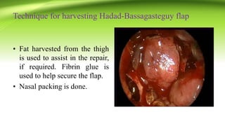 Technique for harvesting Hadad-Bassagasteguy flap
• Fat harvested from the thigh
is used to assist in the repair,
if required. Fibrin glue is
used to help secure the flap.
• Nasal packing is done.
 