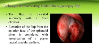Technique for harvesting Hadad-Bassagasteguy flap
• The flap is elevated
anteriorly with a freer
elevator.
• Elevation of the flap from the
anterior face of the sphenoid
sinus is completed with
preservation of a poster
lateral vascular pedicle.
 