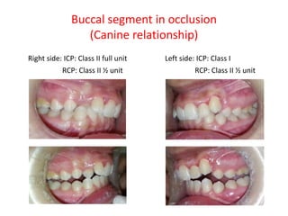 Buccal segment in occlusion
(Canine relationship)
Right side: ICP: Class II full unit Left side: ICP: Class I
RCP: Class II ½ unit RCP: Class II ½ unit
 