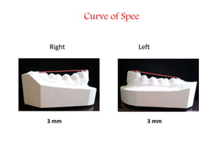 Curve of Spee
Right Left
3 mm 3 mm
 