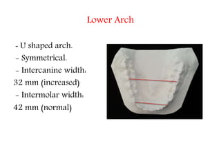 Lower Arch
- U shaped arch.
- Symmetrical.
- Intercanine width:
32 mm (increased)
- Intermolar width:
42 mm (normal)
 