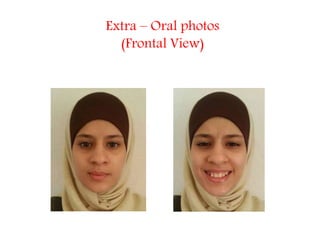 Extra – Oral photos
(Frontal View)
 