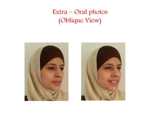 Extra – Oral photos
(Oblique View)
 