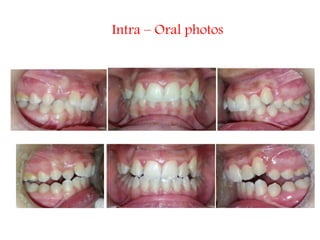 Intra – Oral photos
 