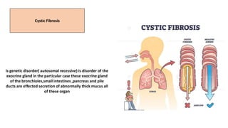 Cystic Fibrosis
is genetic disorder( autosomal recessive) is disorder of the
exocrine gland in the particular case these exocrine gland
of the bronchioles,small intestines ,pancreas and pile
ducts are effected secretion of abnormally thick mucus all
of these organ
 