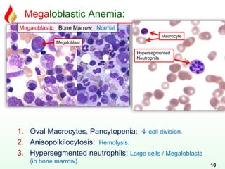 Megaloblastic Anemia:
10
1. Oval Macrocytes, Pancytopenia:  cell division.
2. Anisopoikilocytosis: Hemolysis.
3. Hypersegmented neutrophils: Large cells / Megaloblasts
(in bone marrow).
Megaloblastic Bone Marrow Normal
Hypersegmented
Neutrophils
Macrocyte
Megaloblast
 