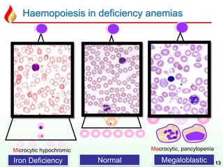 Haemopoiesis in deficiency anemias
13
Macrocytic, pancytopeniaMicrocytic hypochromic
Iron Deficiency Normal Megaloblastic
 